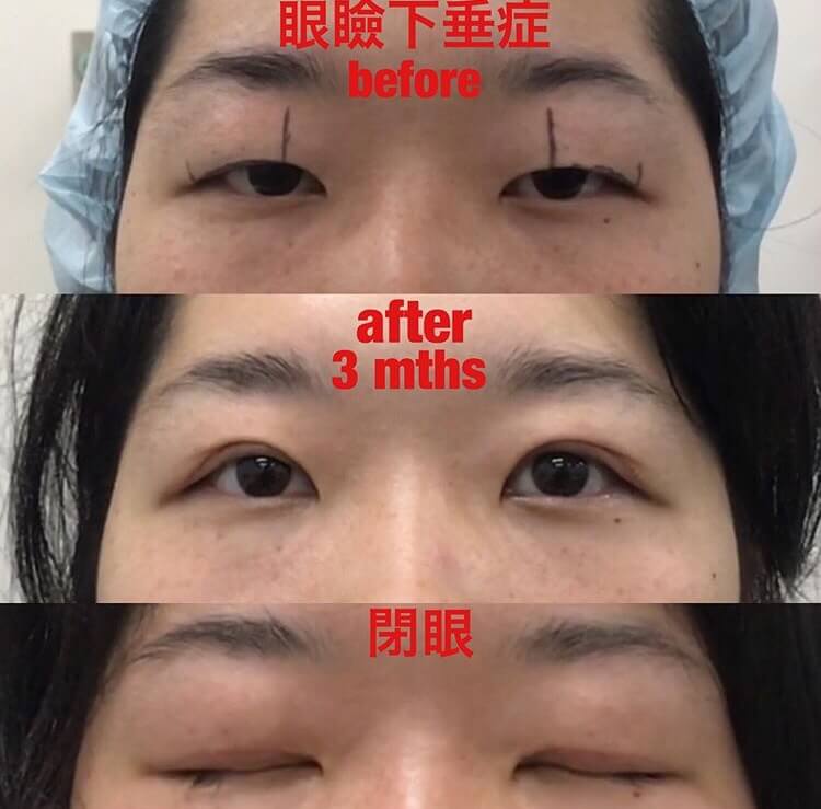 まぶたが重い（切開による眼瞼下垂）