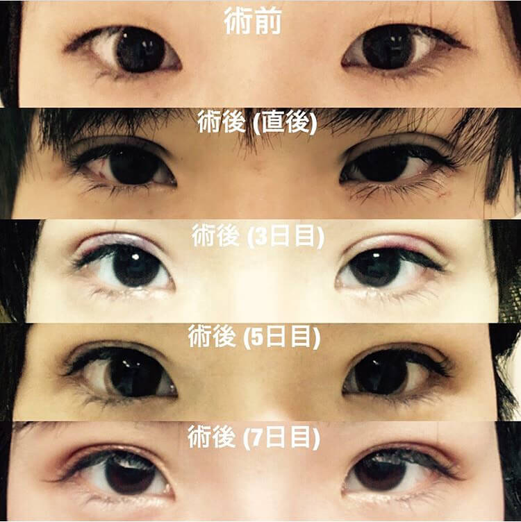 すっきりした自然な二重にしたい(前編)