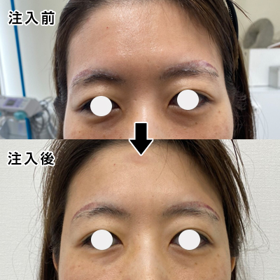 こめかみのヒアルロン酸注入