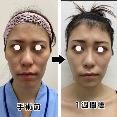 フェイスリフト切開