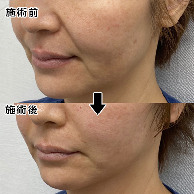 フェイスリフト切開