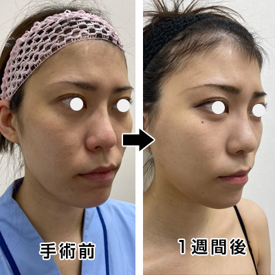 フェイスリフト切開