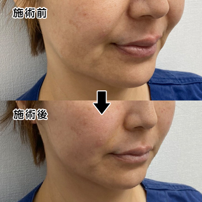 フェイスリフト切開