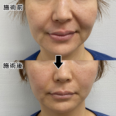 フェイスリフト切開