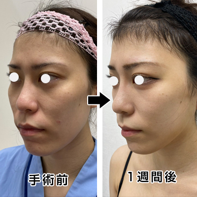 フェイスリフト切開