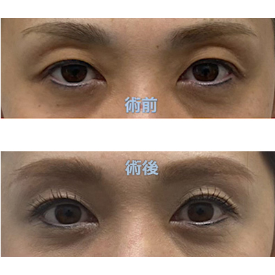 眉下リフト
