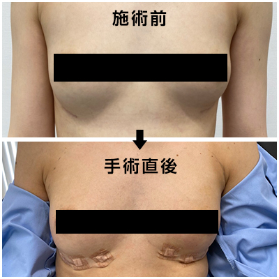 脂肪移植