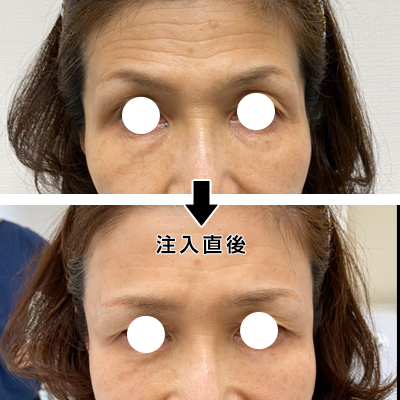 こめかみのヒアルロン酸注入