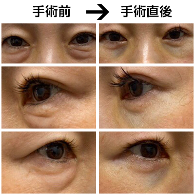 目の下のたるみ取り