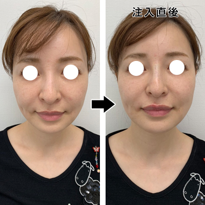 鼻と上唇のヒアルロン酸注入