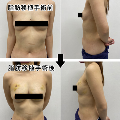 脂肪吸引・脂肪注入