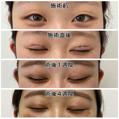 埋没3点留め（目を閉じた状態）