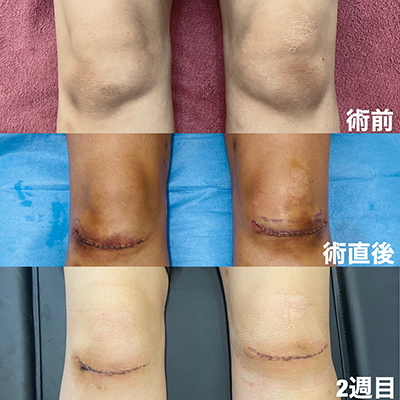 膝の皮膚の切開手術