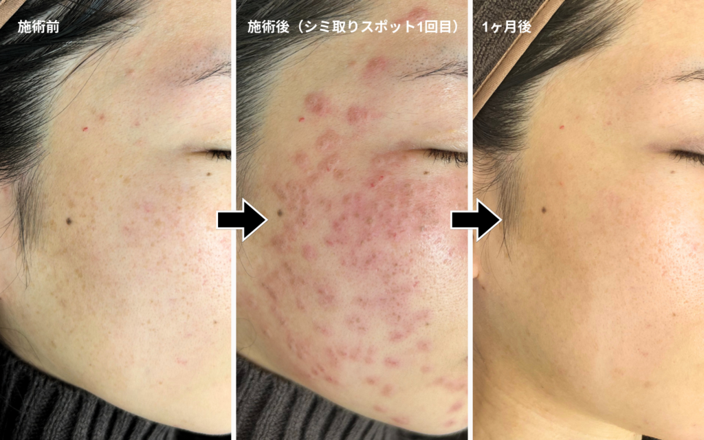 ピコレーザー・シミ取り・トーニング – 栄美容クリニック