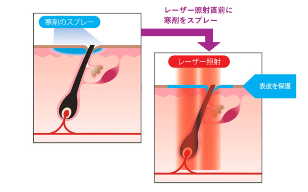 表皮冷却システム「ダイナミッククーリングデバイス（DCD）